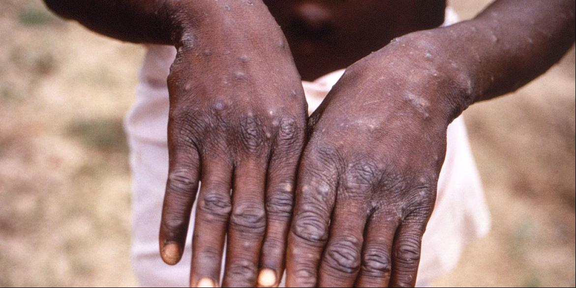Erupções na pele são uma das características da doença (Centers for Disease Control and Prevention / Brian W.J. Mahy)